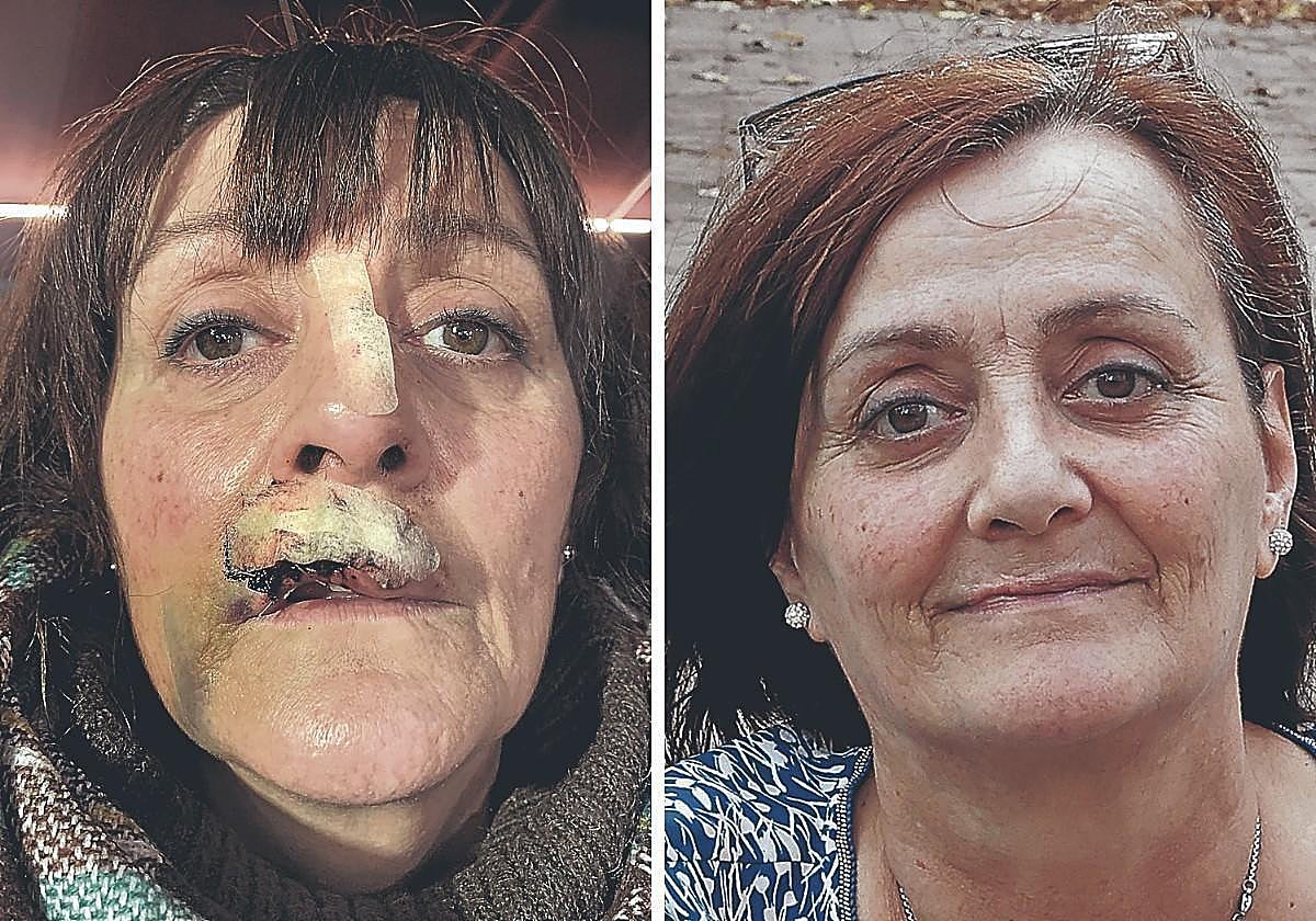 Picture of Nuria shortly after the dog attack in Barakaldo. On the right, a current photograph