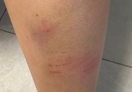 One of the injuries suffered by the child.