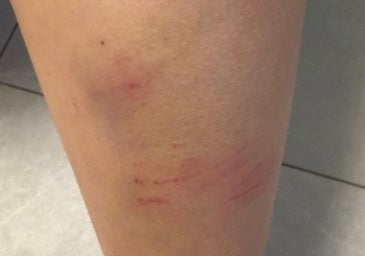 One of the injuries suffered by the child.