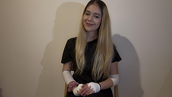 Malaga influencer Micaela with epidermolysis bullosa (Butterfly Skin): daily tips for 140K followers
