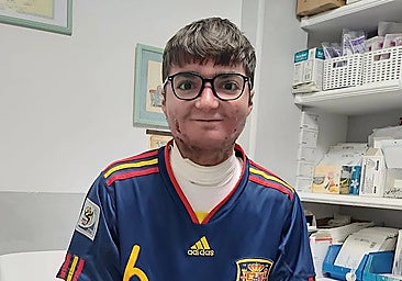 22-year-old Adrián Soto suffers from epidermolysis bullosa, also known as 'butterfly skin'.