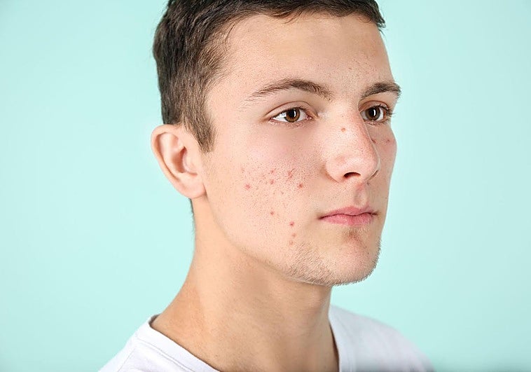 Adult acne: causes, treatments and mistakes to avoid