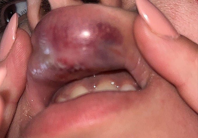 Injury sustained by one of the women during the attack on 15 May