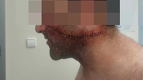 Malaga healthcare worker needs 30 stitches after having face slashed by stranger