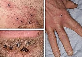 Skin lesions caused by monkeypox infection.
