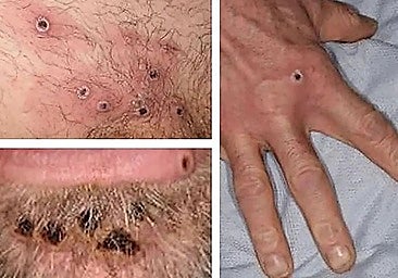Skin lesions caused by monkeypox infection.