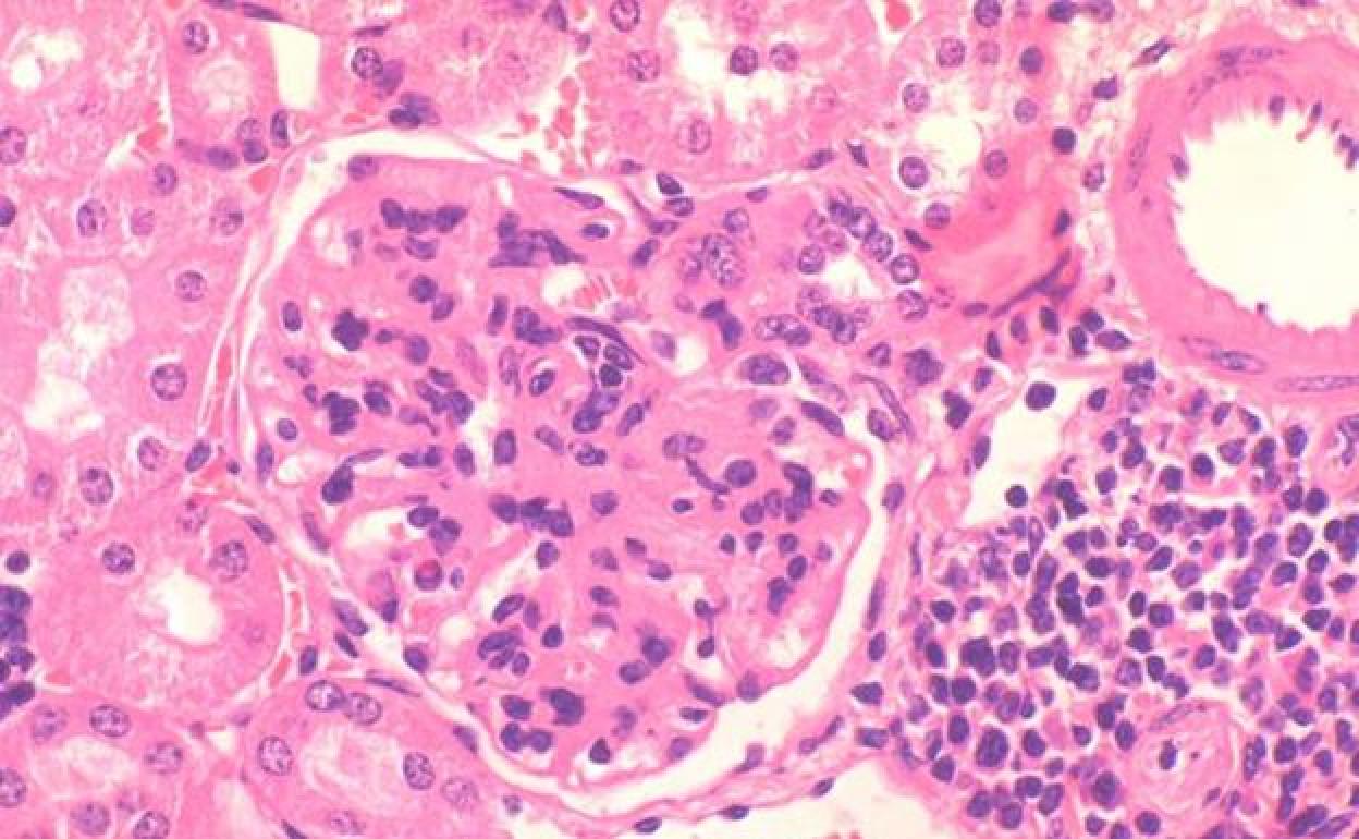 Una innovadora terapia permite superar el lupus a cinco pacientes alemanes